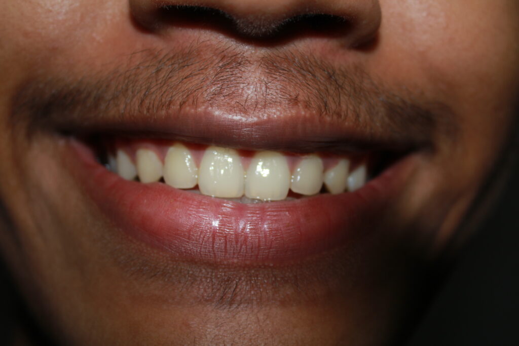 close-up-midsection-smiling-teenage-boy Close-up of healthy gums and teeth after professional dental cleaning