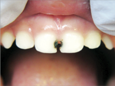 A child's cavity treated with silver diamine fluoride.