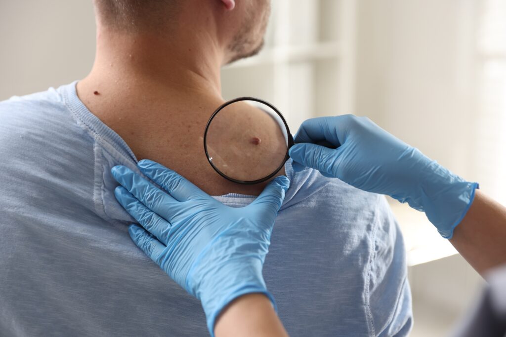 a doctor examining a mole on a person's back using a magnifying glass