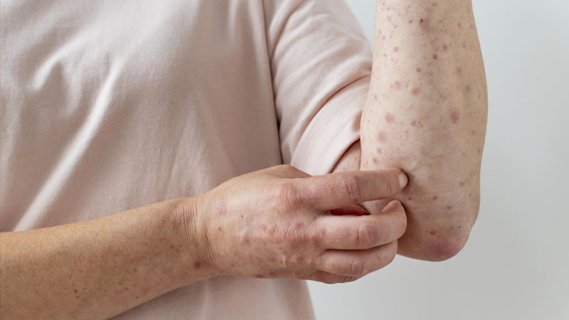 a person scratching their elbow because they have measles